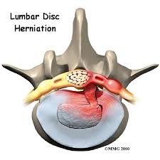 Disc Herniated