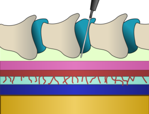 epidurialdiagram