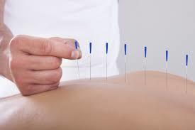 acupuncture