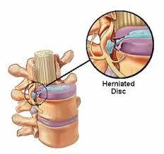 How To Heal A Herniated Disc Naturally 
