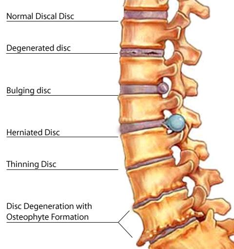 spinal problems