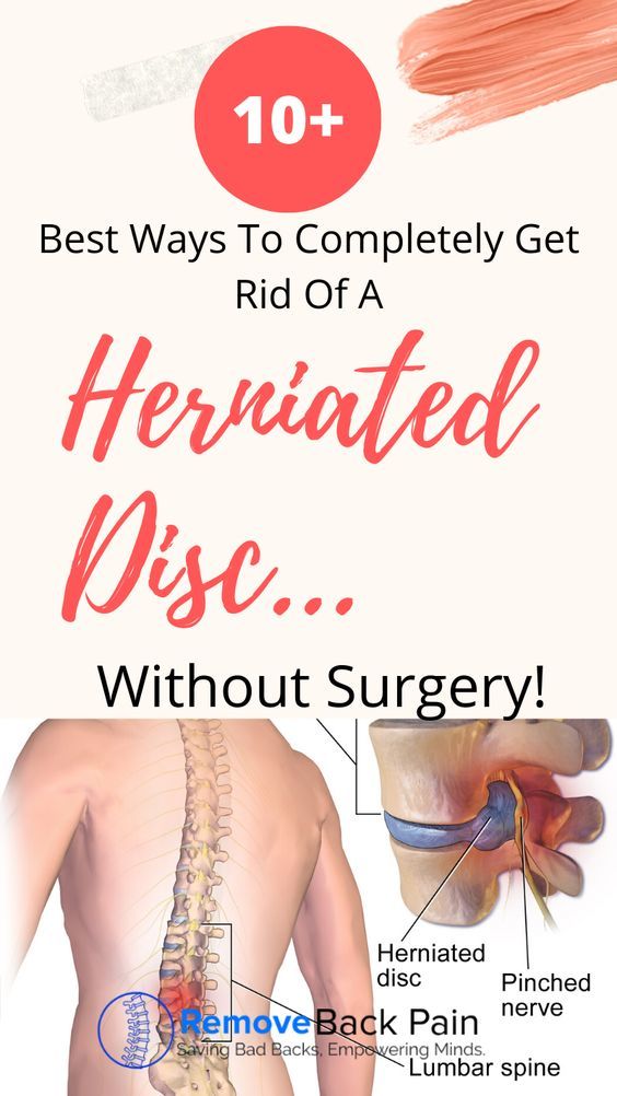 10 Ways On How To Heal A Herniated Disc Naturally - Cured