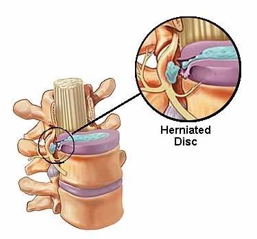 herbal remedies for herniated disc